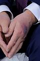 trump-bruising