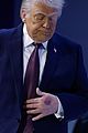trump-bruising