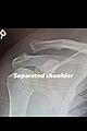 channing-shoulder